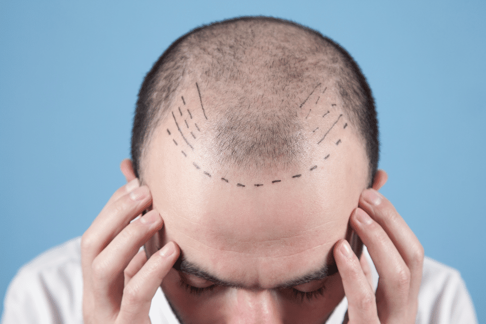 Botched Hair Transplant Caused Disfigurement, Lawsuit | Levin & Perconti