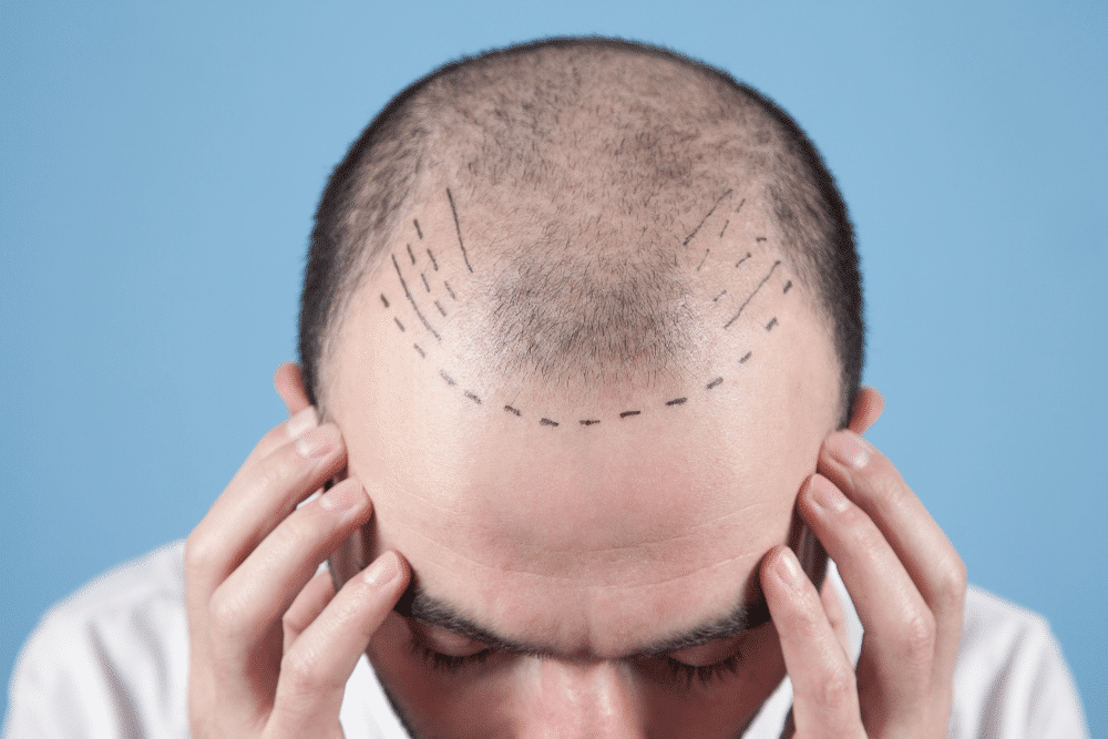 Hair transplant patient