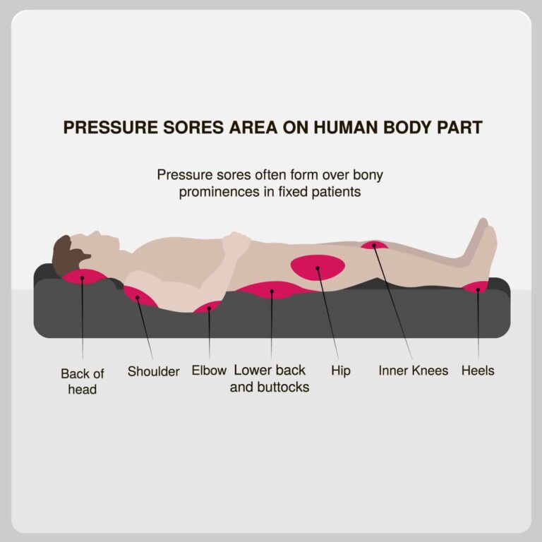 pressure sores area on human body part