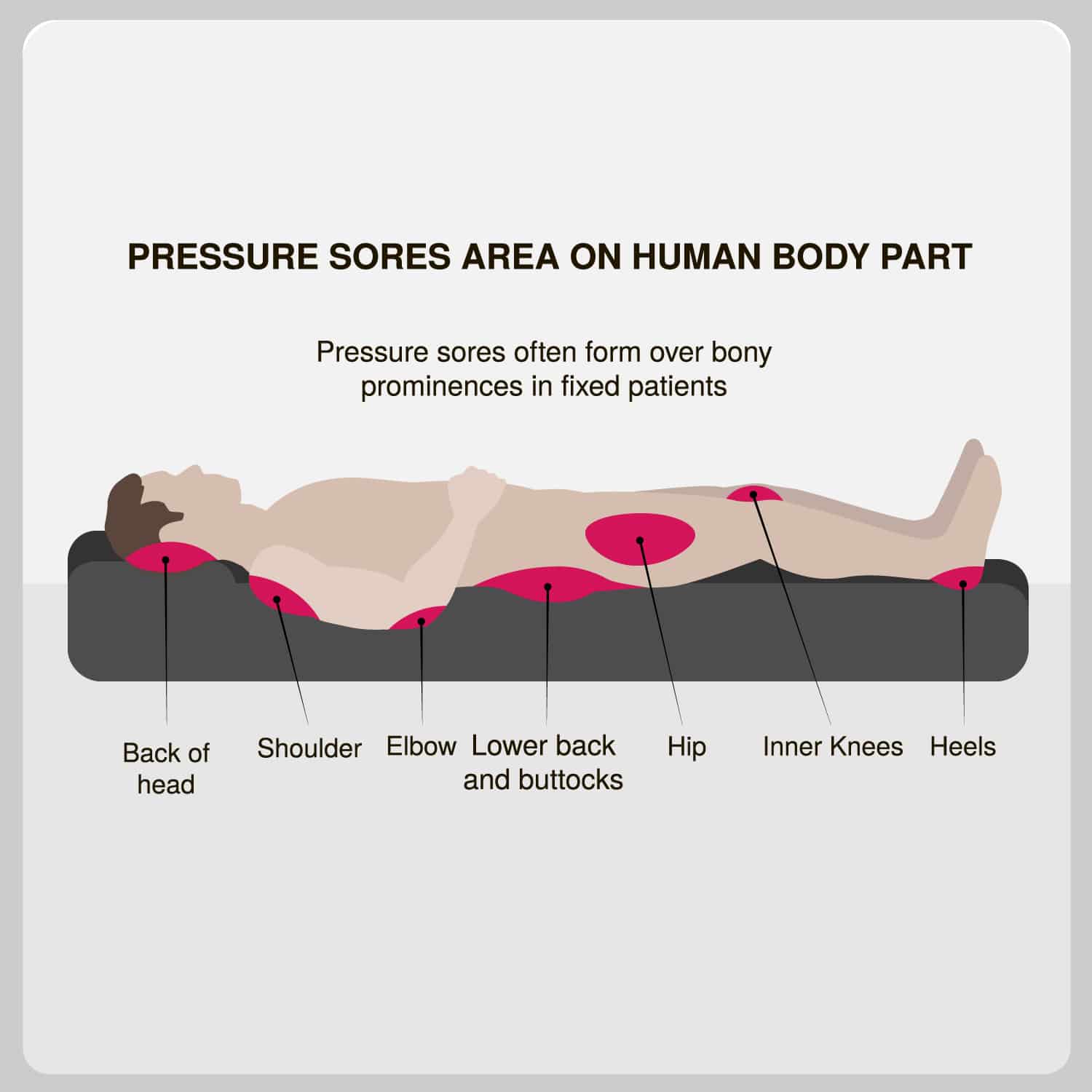 Pearls for Practice: Treating Stage III Pressure Ulcers