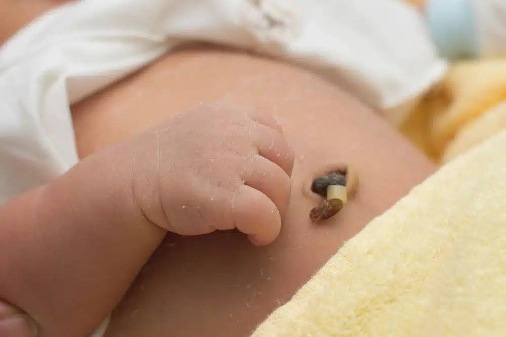 Image of a baby's belly button