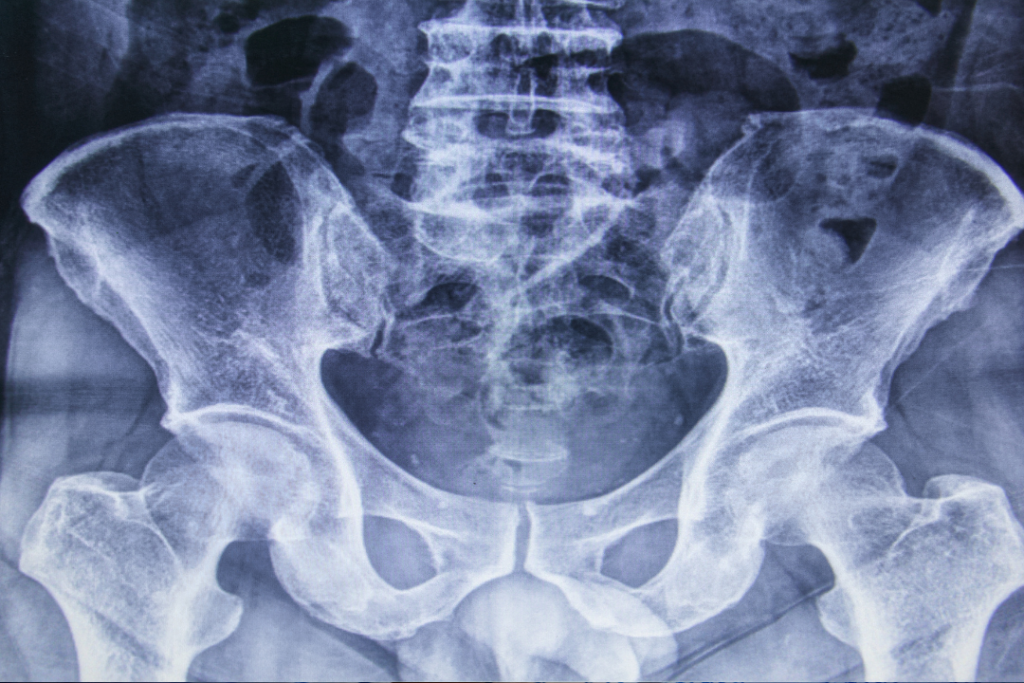 a pelvic x-ray where a radiologist missed a tumor